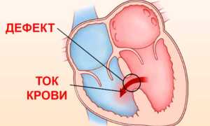 Порок сердца: симптомы и признаки