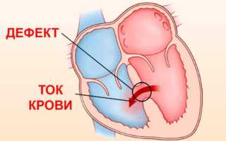 Порок сердца: симптомы и признаки