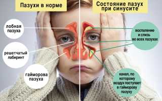 Использование Амоксициллина при лечении гайморита