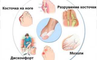 Бурсит большого пальца стопы: что за проблема и как её решить?
