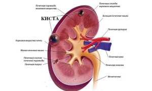 Киста левой почки: почему появляется и как лечится