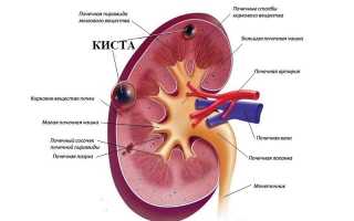 Киста левой почки: почему появляется и как лечится