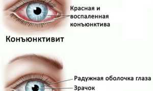 Острый конъюнктивит: первые симптомы и эффективное лечение