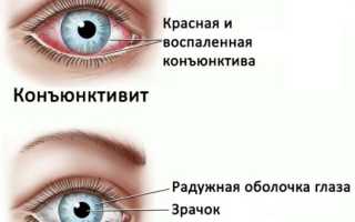 Острый конъюнктивит: первые симптомы и эффективное лечение