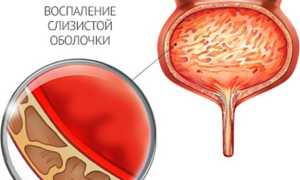 Острый цистит: особенности течения и лечения патологии