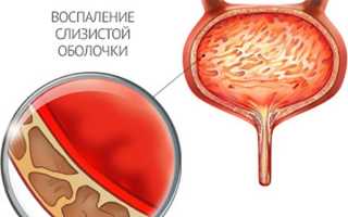 Острый цистит: особенности течения и лечения патологии