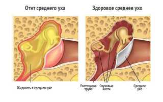 Экссудативный отит — как предотвратить потерю слуха у ребёнка