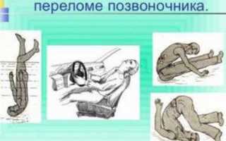 Как лечить повреждение спинного мозга