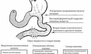 Демпинг-синдром или болезнь оперированного желудка: как помочь больному?