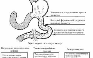 Демпинг-синдром или болезнь оперированного желудка: как помочь больному?