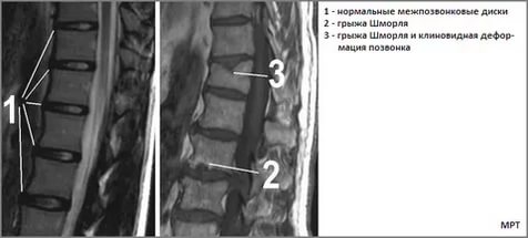 Грыжа Шморля грудного отдела позвоночника