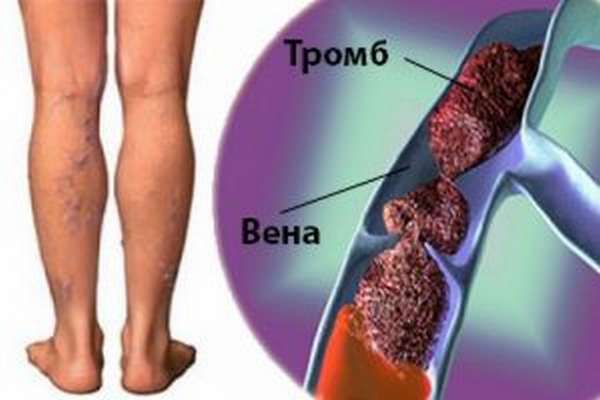 Признаки и лечение хронической венозной недостаточности