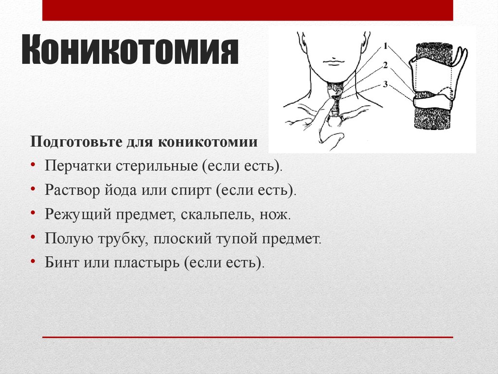 коникотомия
