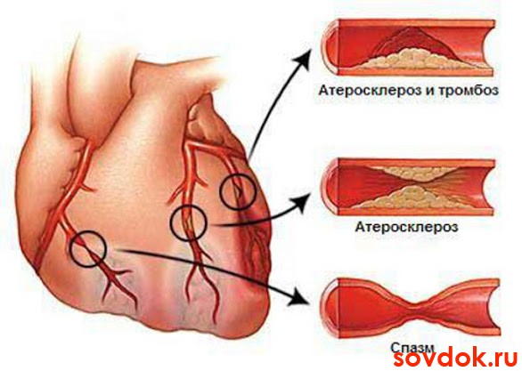 Причины ишемии