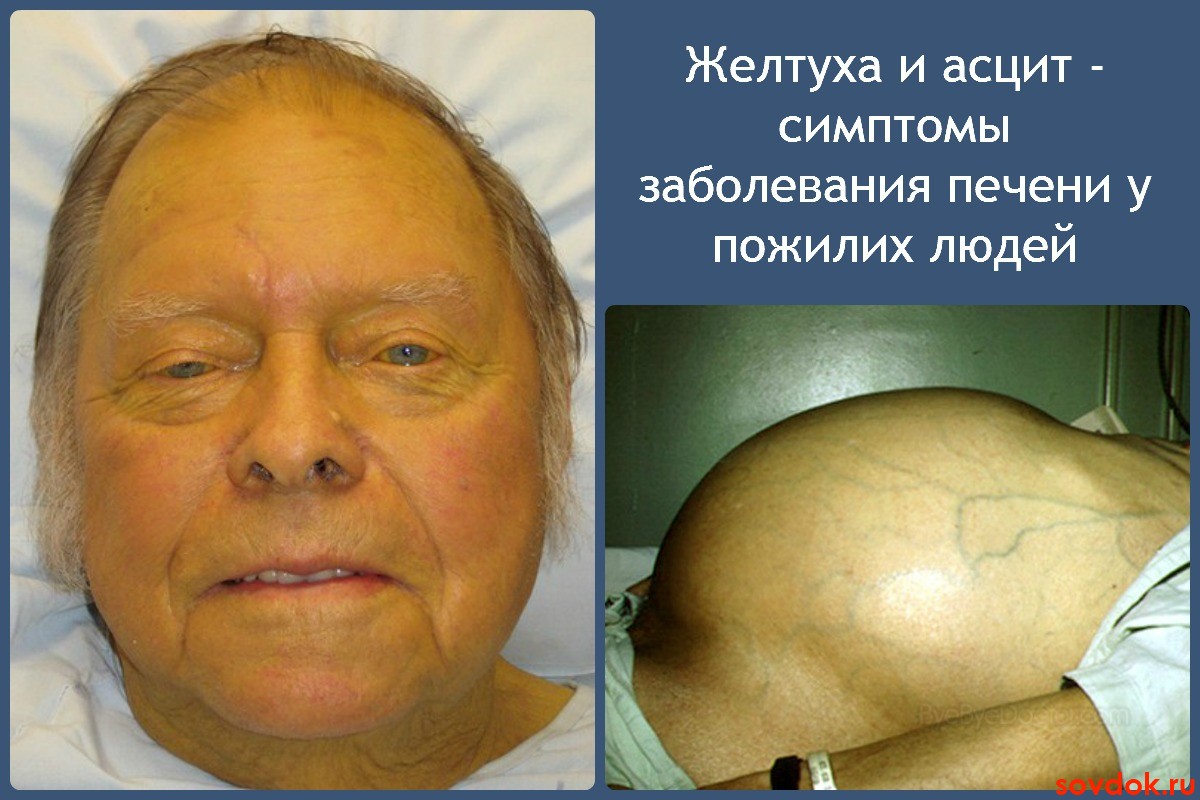 Желтуха и асцит - симптомы заболевания печени у пожилих людей