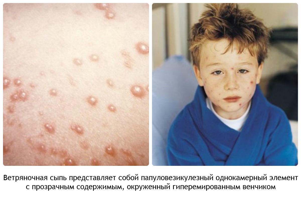 сыпь при ветрянке