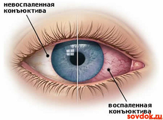 Воспалённый глаз