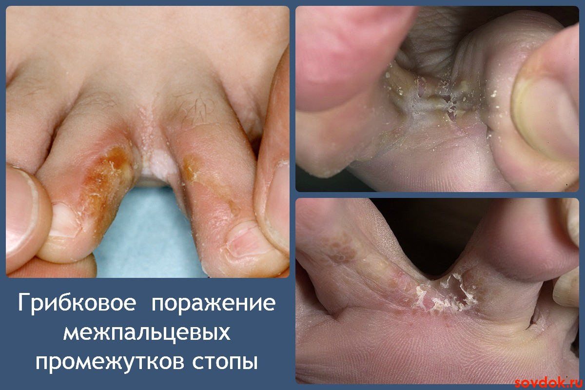 Грибковое поражение межпальцевых промежутков стопы