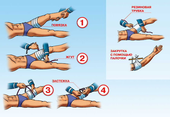 Онтикоагулянты – профилактика тромбоза
