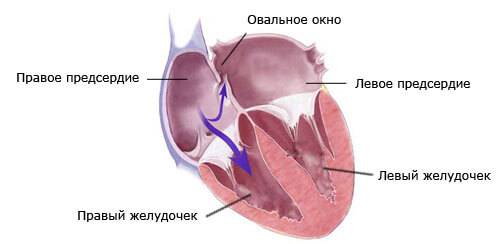 Отрытое овальное окно в сердце на поперечном разрезе