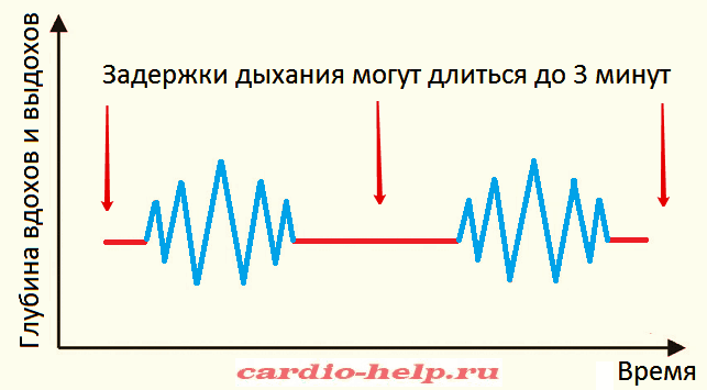 Спирограмма дыхания Чейна-Стокса