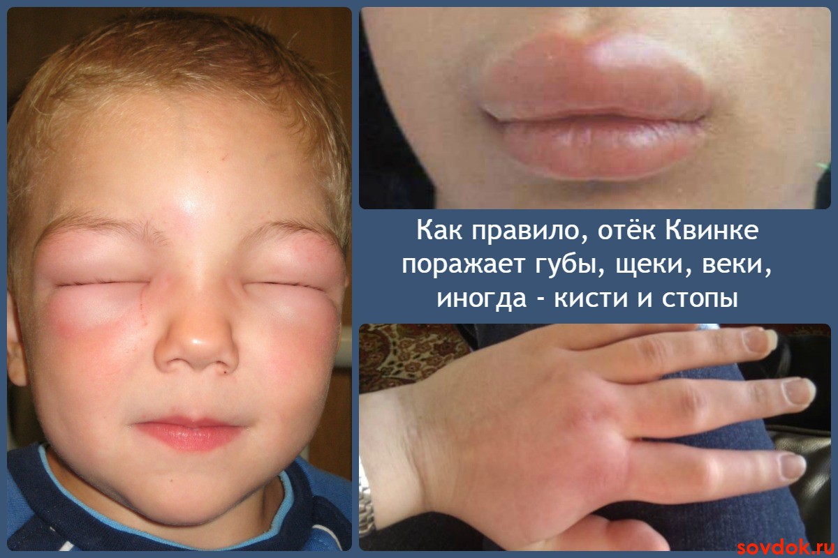 Области поражения отёка Квинке