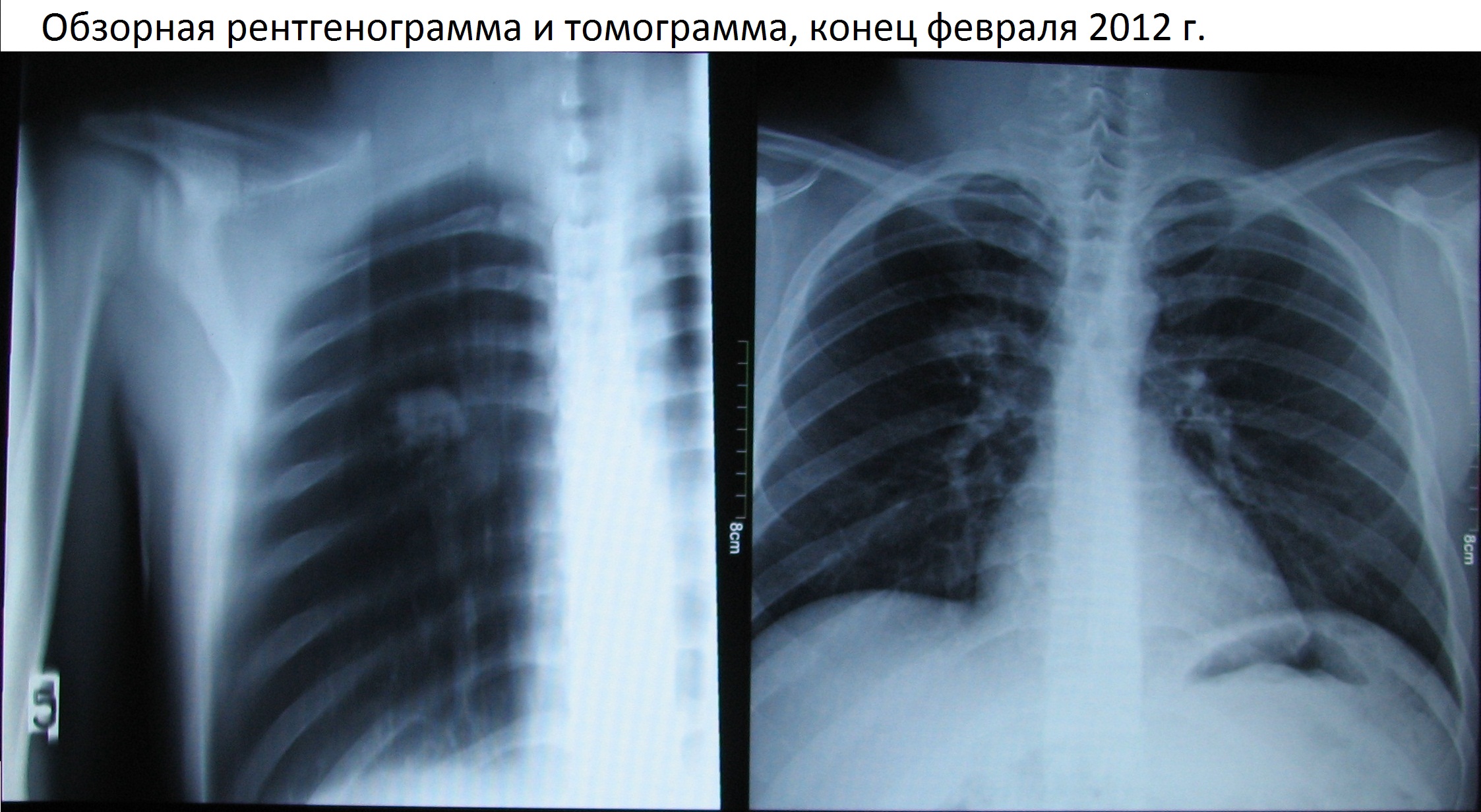 очаг туберкулеза на рентгене