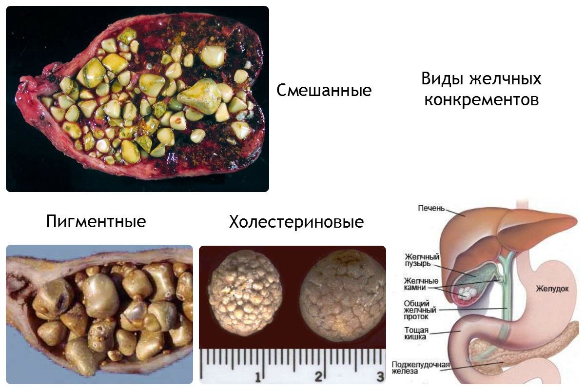 камни в желчном