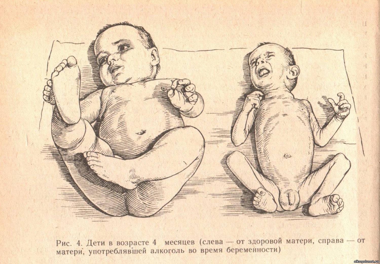 ребёнок родившийся у алкоголиков