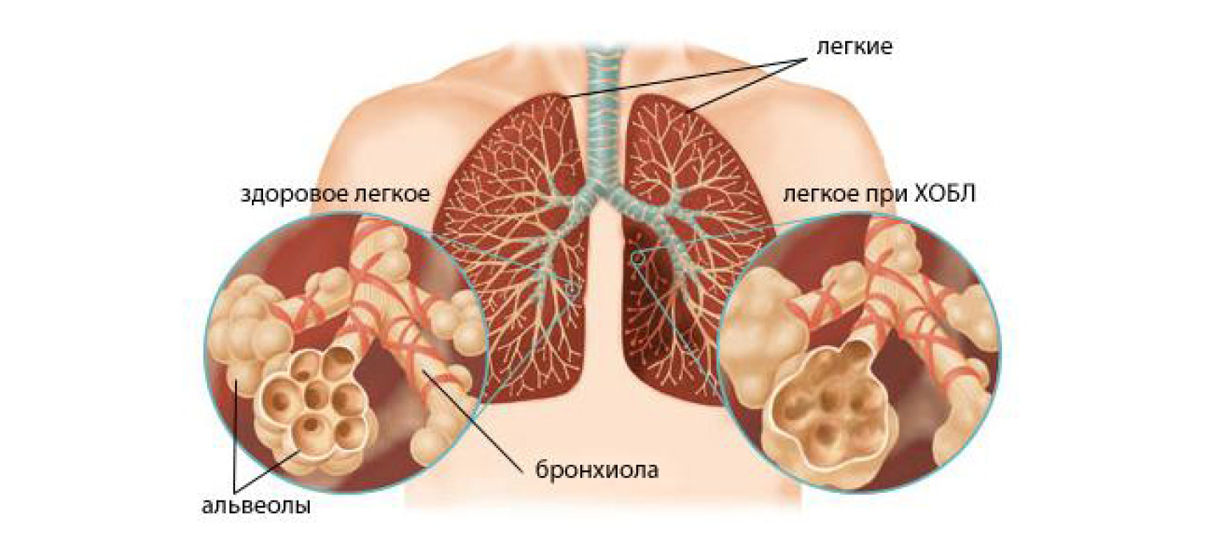больные легкие хозл