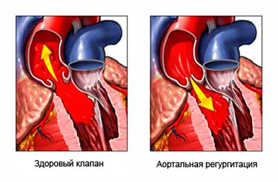 Недостаточность аортального клапана