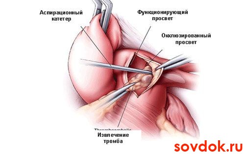 Лечение тромбоза