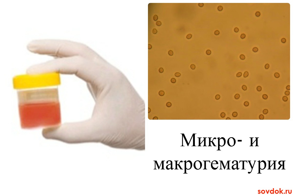 Микрогематурия и макрогематурия