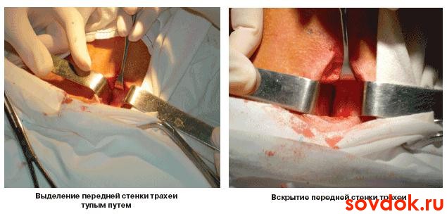 Проведение трахеостомии этап 3 и 4