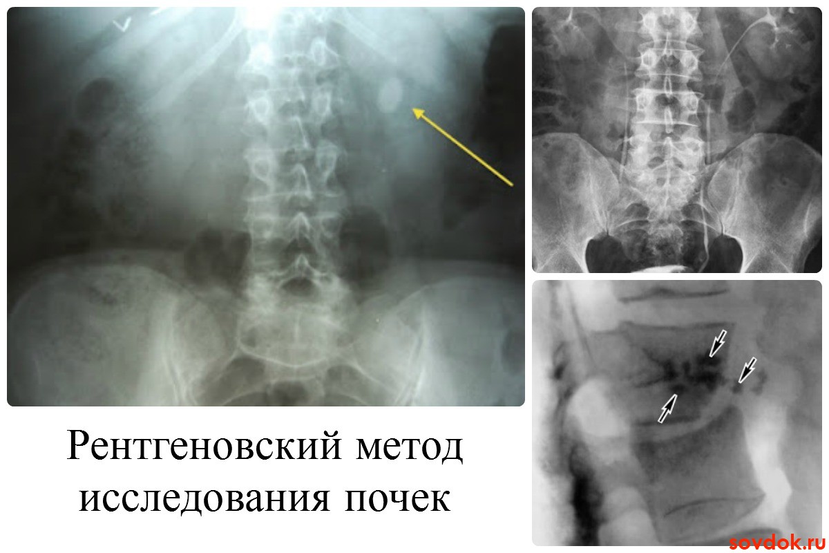 Рентгеновский метод исследования почек