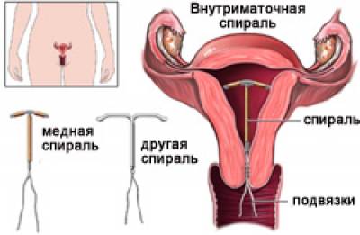 Внутриматочная спираль