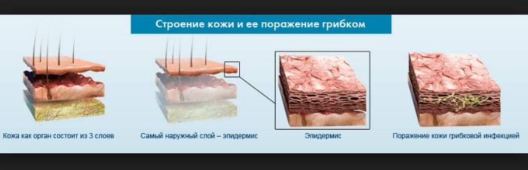Строение кожи и её поражение грибком
