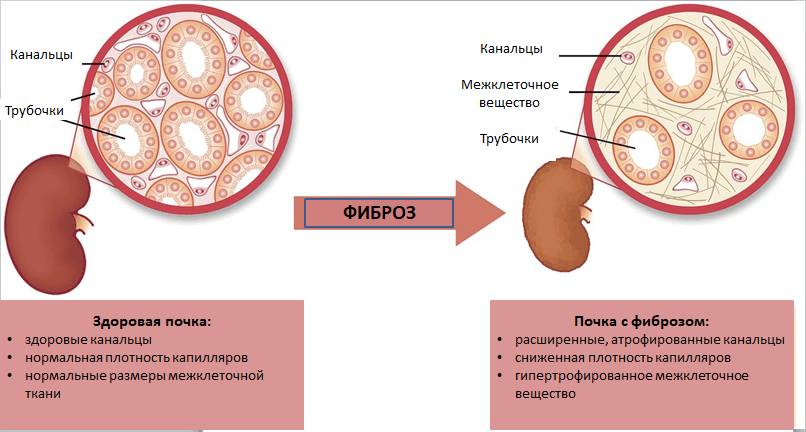 Фиброзные изменения в почке (схема)