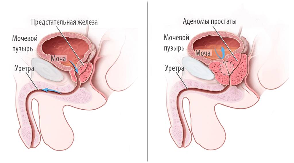 Аденома простаты (схема)