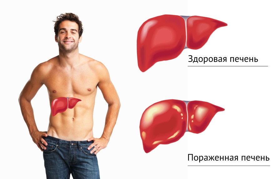 алкогольный гепатит
