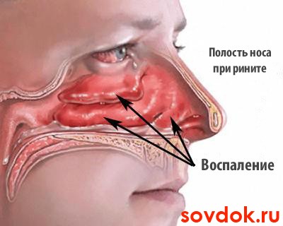 аллергический ринит