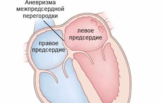 Аневризма межпредсердной перегородки у взрослых