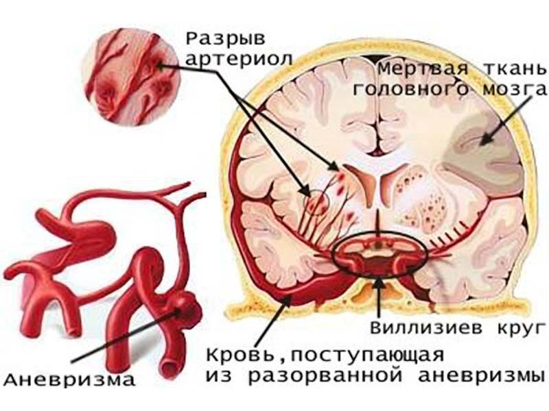 схема разрыва аневризмы