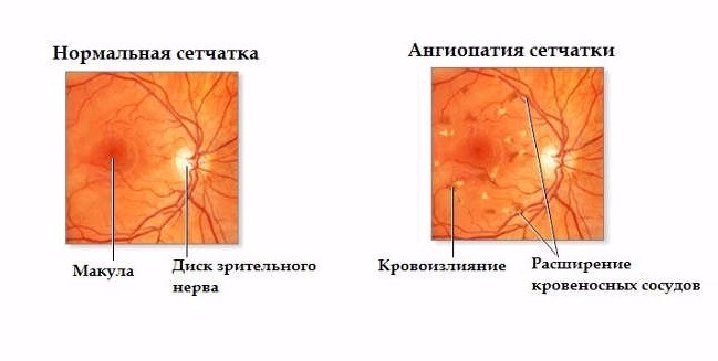 схема ангиопатии сетчатки