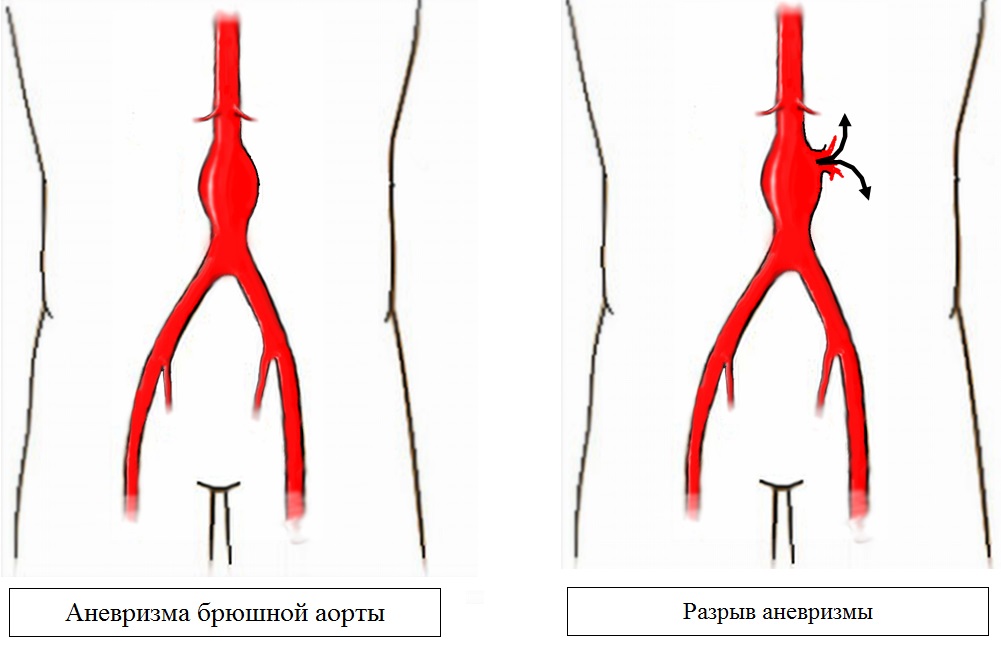Разрыв аневризмы
