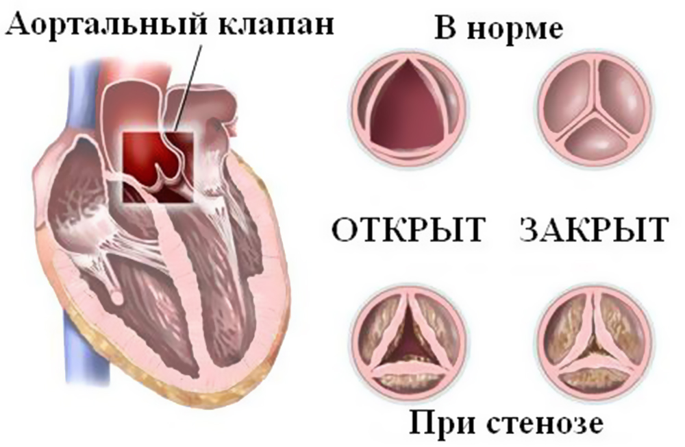 Аортальный клапан