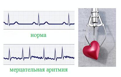 Аритмии