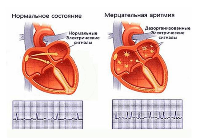 Аритмия