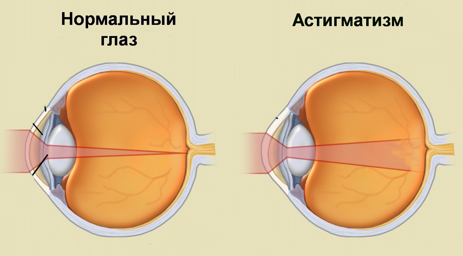 Астигматизм