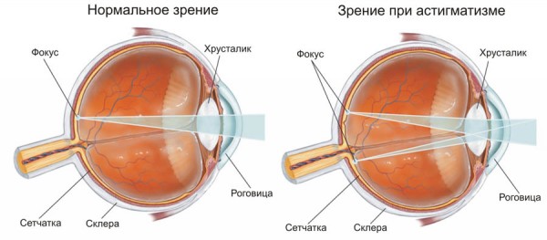 Астигматизм (схема)